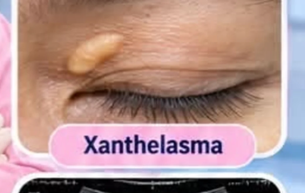 Xanthelasma Removal Xanthelasma: a yellow cholesterol deposit on the upper eyelid, before removal